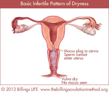 Basic Infertile Pattern of Dryness